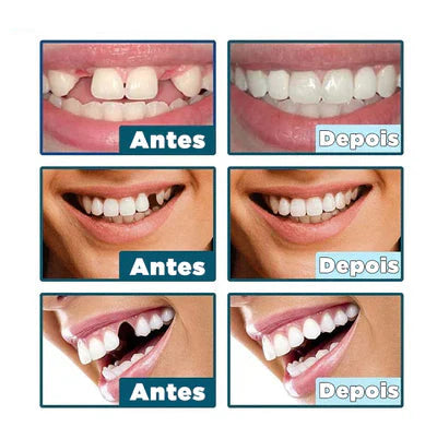 Facetas Dentárias Naturais Removíveis 2 por 1 | SmileFix Pro [Leve2 e pague 1]